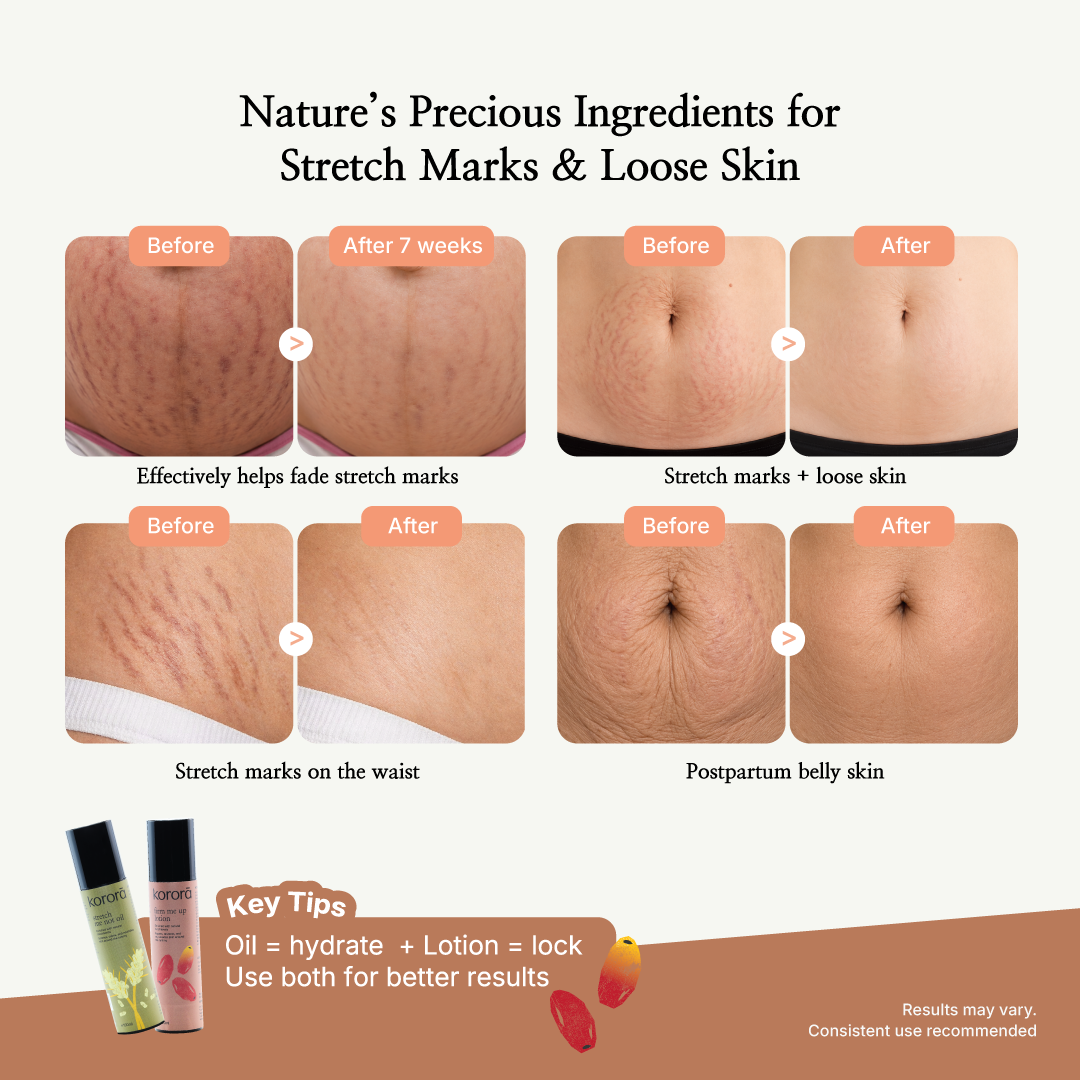 Korora Mom Series | Stretch Me Not Oil & Firm Me Up Lotion
